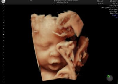 Ecografie 3D / 4D - Ginecologie Botosani - 4Life Women's Health Center
