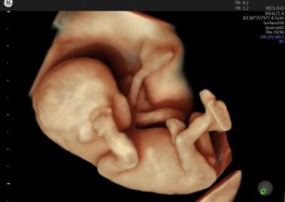 Ecografie 3D / 4D - Ginecologie Botosani - 4Life Women's Health Center