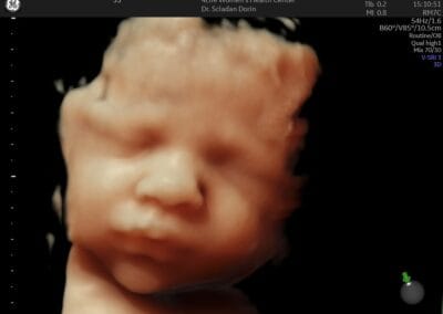 Ecografie 3D / 4D - Ginecologie Botosani - 4Life Women's Health Center