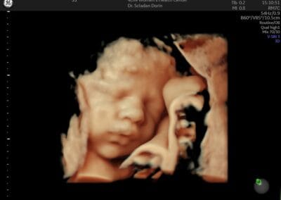 Ecografie 3D / 4D - Ginecologie Botosani - 4Life Women's Health Center