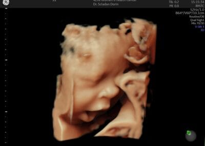 Ecografie 3D / 4D - Ginecologie Botosani - 4Life Women's Health Center