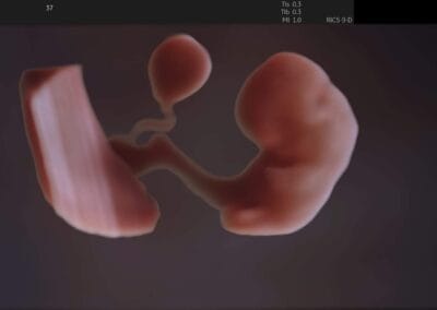 Ecografie 3D / 4D - Ginecologie Botosani - 4Life Women's Health Center